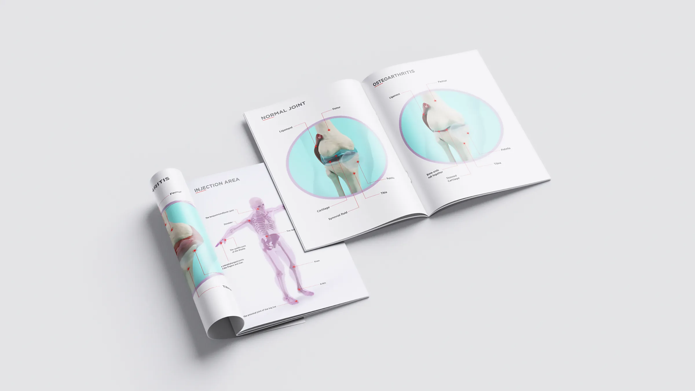 Unutrašnje duplerice koje porede zdrav zglob sa osteoartritisom, svaki deo označen